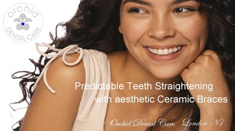Predictable Teeth Straightening with aesthetic Ceramic Braces