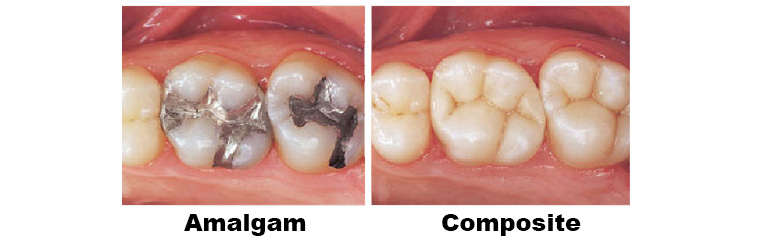 amalgam filling-silver filling-white filling