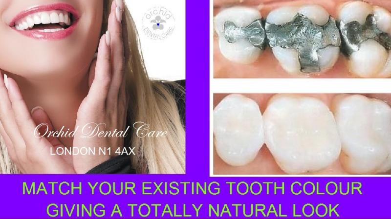 white filling, composite filling, tooth colored filling